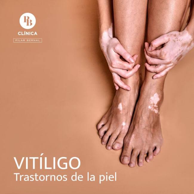 VITILIGO
